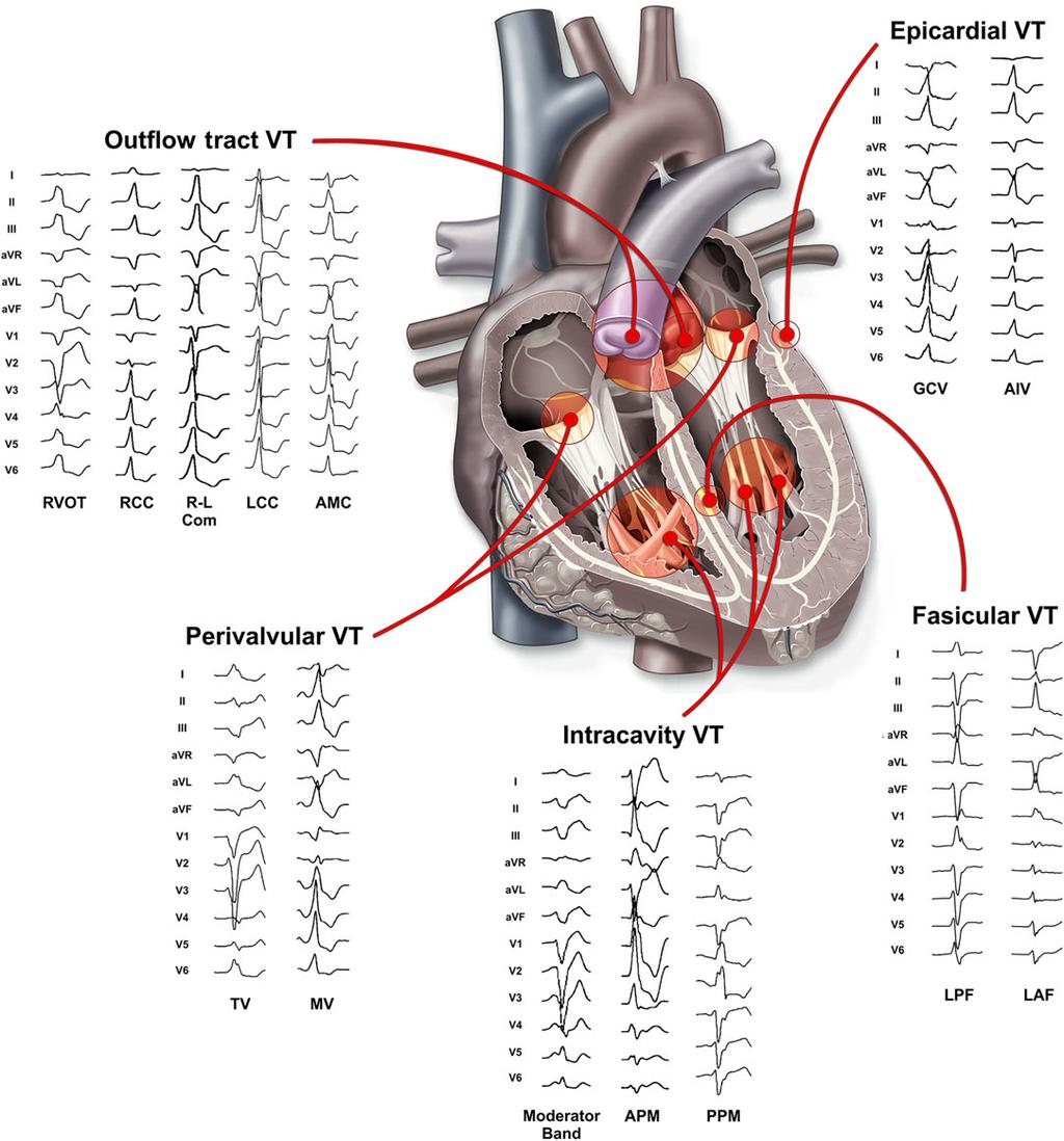 Catheter in Page 3 of 19 Figure 1 Twelve-lead electrocardiogram morphology of different sites of origin in idiopathic ventricular tachycardia (RVOT, right ventricular outflow tract; RCC, right