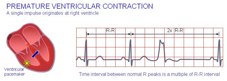Premature heartbeats originating from the ventricles of the heart. A sign of decreased oxygenation to the heart muscle. PVCs are benign and may even be found in healthy hearts.