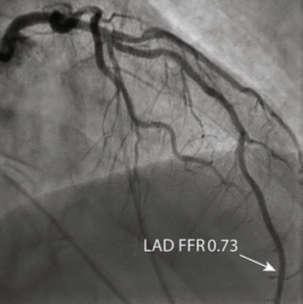 angiography 