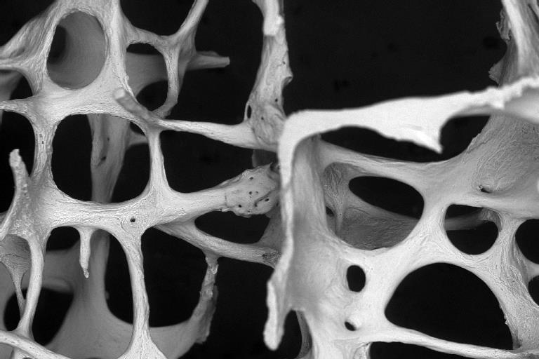Osteoporotic bone architecture in 3rd lumbar