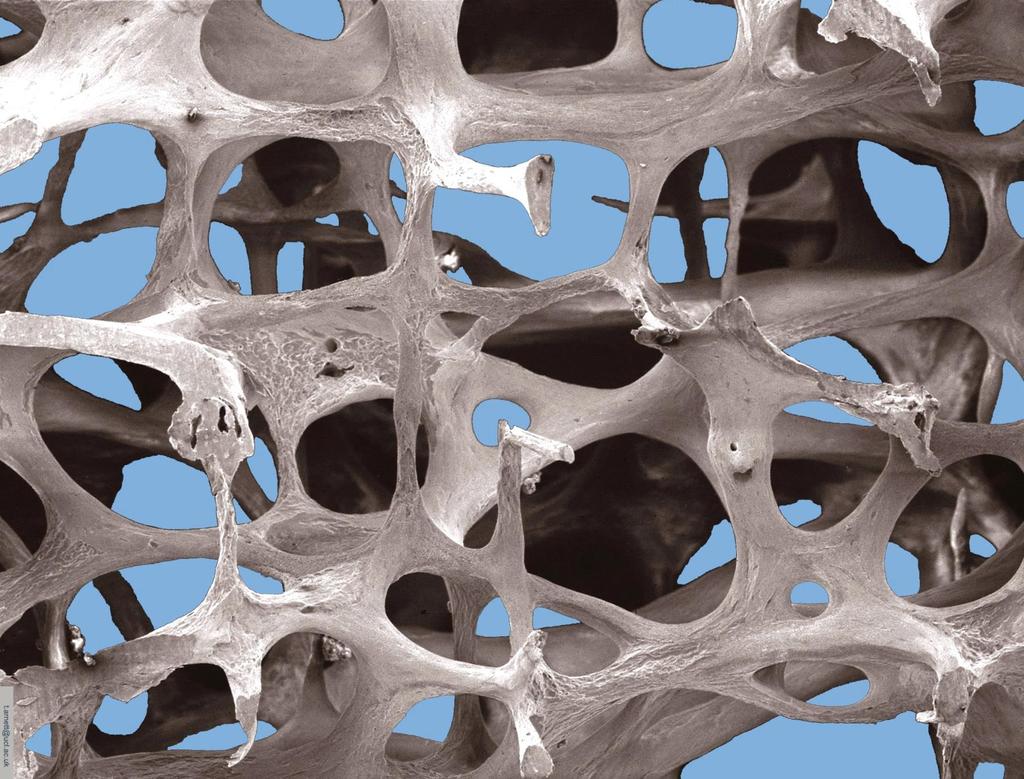 Low-power scanning electron microscope image of osteoporotic bone