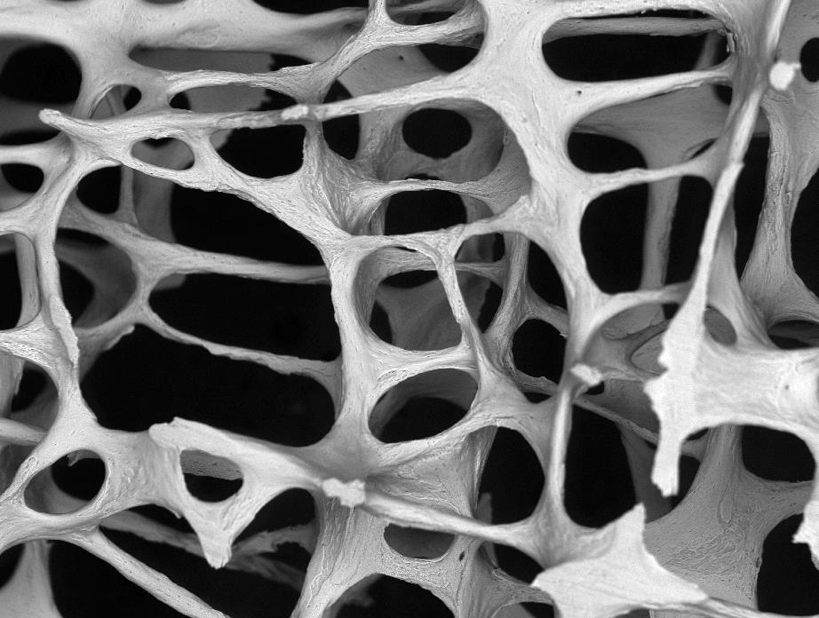 Osteoporotic bone architecture in 3rd lumbar