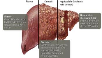 Chronic HCV Leading to Cirrhosis and Hepatocellular Cancer Slide 8 of 35 Wouldn t It Be Great.