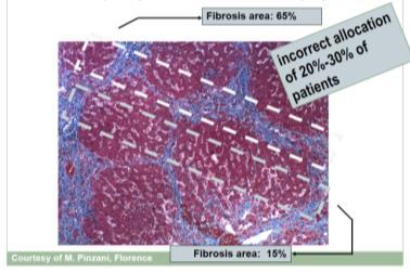 Sampling Error Slide 17 of 35 Indirect Markers of Fibrosis Use