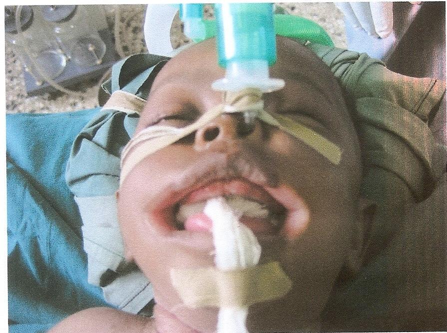 Case Reports 127 Case 1 The first patient was a 5-month old baby boy with bilateral facial clefts.