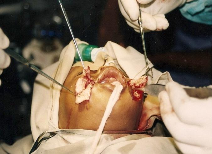 128 Figure 5. Intraoperative Z Plasty flaps Figure 6. Immediate post operative picture. Case 2 The second patient was a 15 month old male child who presented with bilateral facial cleft.