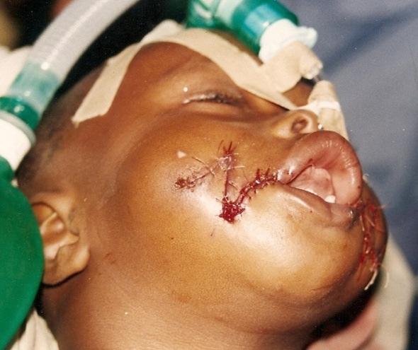 His physical examination revealed bilateral facial cleft. He did not have any other anomaly.