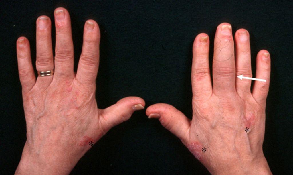 Dactylitis : known as sausage toe or sausage finger.