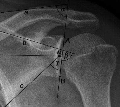 The neoglenoid (d) represents the face of the glenoid created from wear by the humerus. (Adapted from Rouleau et al.