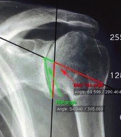 1 Evaluation of Humeral and Glenoid Bone Deformity in Glenohumeral Arthritis 11 rotations commonly seen during clinical practice with variations in patient positioning during x-ray.