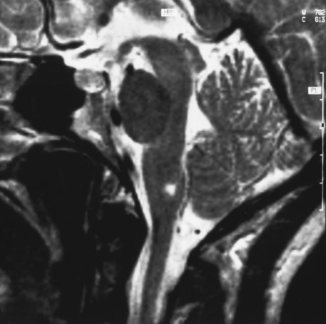 lesion, and axial T 1 -weighted spin-echo MR image (bottom) a hypointense lesion in the caudal