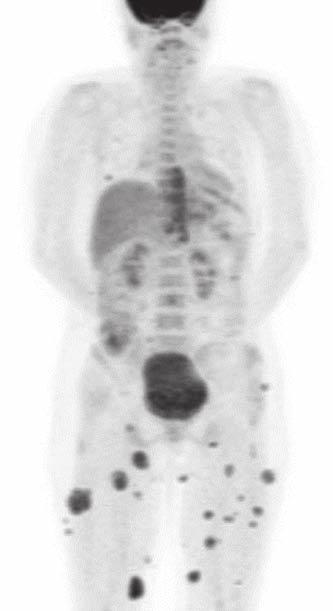 Fig. 5 49-year-old woman who previously had acute myeloid leukemia and bone marrow transplantation.