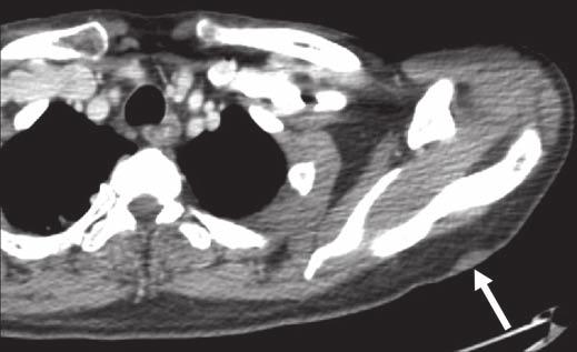 xial contrastenhanced CT image shows myeloid sarcomatous skin deposit (white arrow), known as leukemia cutis, which is not