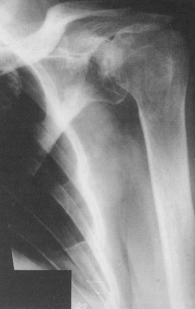 40 S~rjbjerg et al Clinical Orthopaedics and Related Research The present study reports the long term survival and complications after total shoulder replacement in patients suffering from severe
