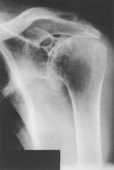 Number 366 September, 1999 Late Results of Total Shoulder Replacement 41 Fig 3. Radiograph of a shoulder with rheumatoid arthritis of the resorptive type.