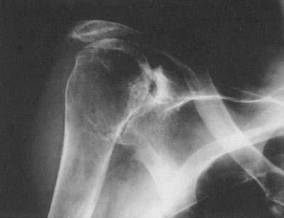 Radiograph of a shoulder with rheumatoid arthritis of the wet type, showing the characteristic appearance of the proximal migrated humeral head caused by rotator cuff deficiency.