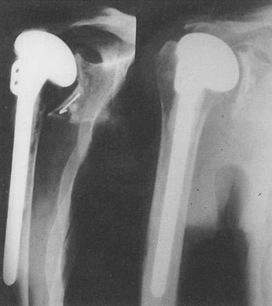 Number 366 September, 1999 Late Results of Total Shoulder Redacernent 43 mm, rarely extended beyond the superior 'h of the humeral stem, and none were progressive. There were no cases of subsidence.
