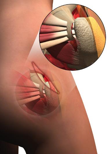 The posterior approach requires a large incision, and several muscle structures are traumatized.