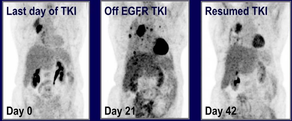 EGFR Tumor Flare Riely GJ, et al.