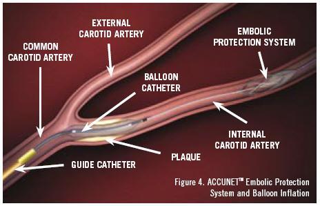 Carotid Artery Stenting Long term outcomes Stroke: 10yrs ~6.9% **NS difference from CEA** Restenosis rate(>50%) 6% at 1 year 10.