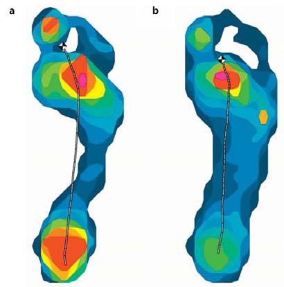 Age-Related Changes in Foot Posture and Dynamic Foot Function N=619 Foot arch shock attenuation Generate power for propulsion Aging Gradual lowering of the arch Greater medial displacement of the CoP
