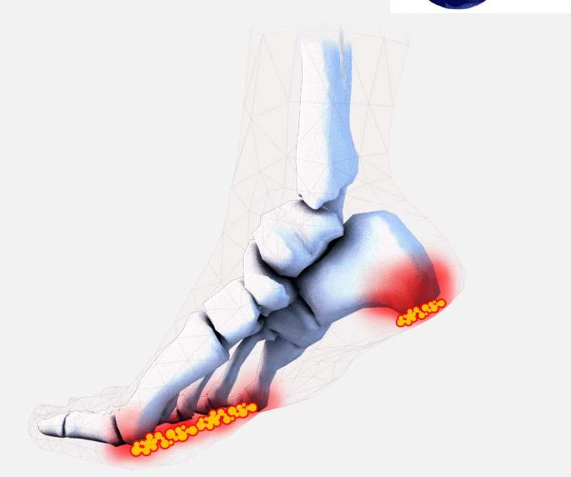 Age-Related Changes in Plantar Soft Tissues Deeper pad Aging DFU risk Better protection underlying blood vessels and nerves Better attenuation of shear forces Better attenuation of pressure and