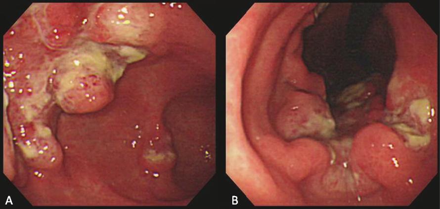 C. H. Wu et al./jcrp 27(2011) 117-122 119 Figure 1. The gastroendoscopic examination revealed multiple nodal and ulcerative lesions between the lower (A) and upper body (B) A B C Figure 2.