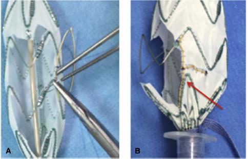 Method: stent-graft modification Radiopaque markers were