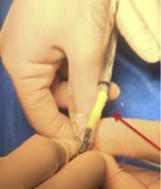 Method: stent-graft