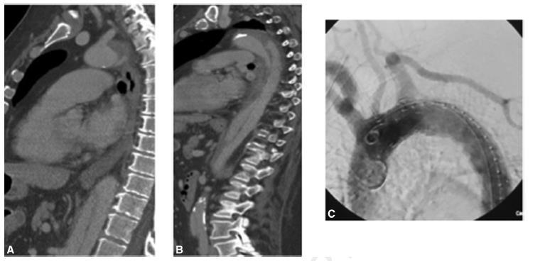 Physician modified thoracic stent-grafts for the treatment of aortic arch lesions 36 patients: 27 men Mean age, 74.