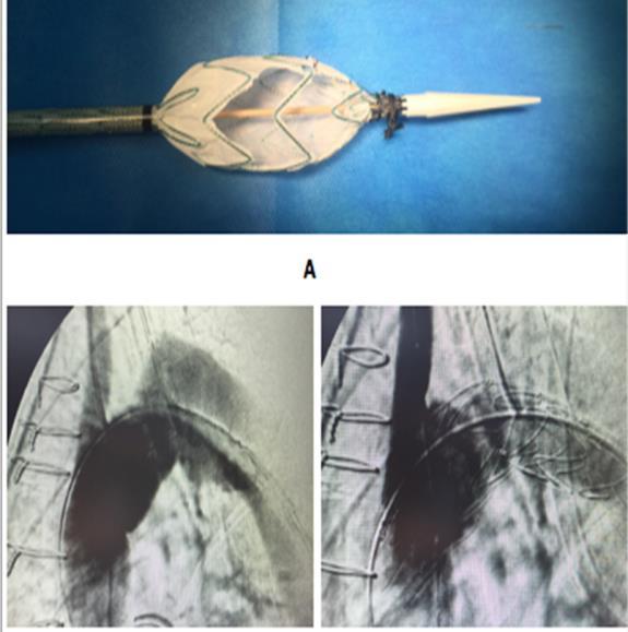 Discussion Special anatomic considerations Aneurysmal ascending aorta Ascertaining that the fenestration or the scallop is well oriented toward the supra-aortic trunk target