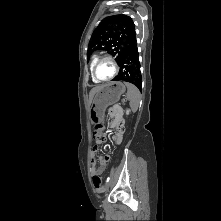 Complete false lumen thrombosis after coverage of whole aortic communicating holes Before endografting Post