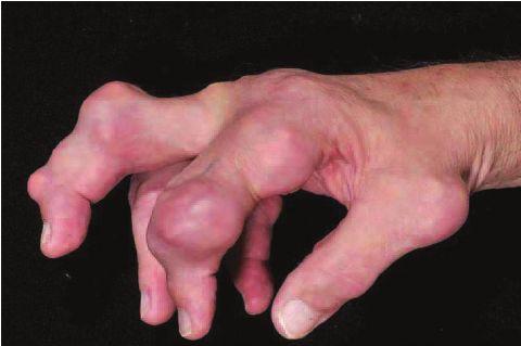 arthritis with red, tender, hot and swollen joints.