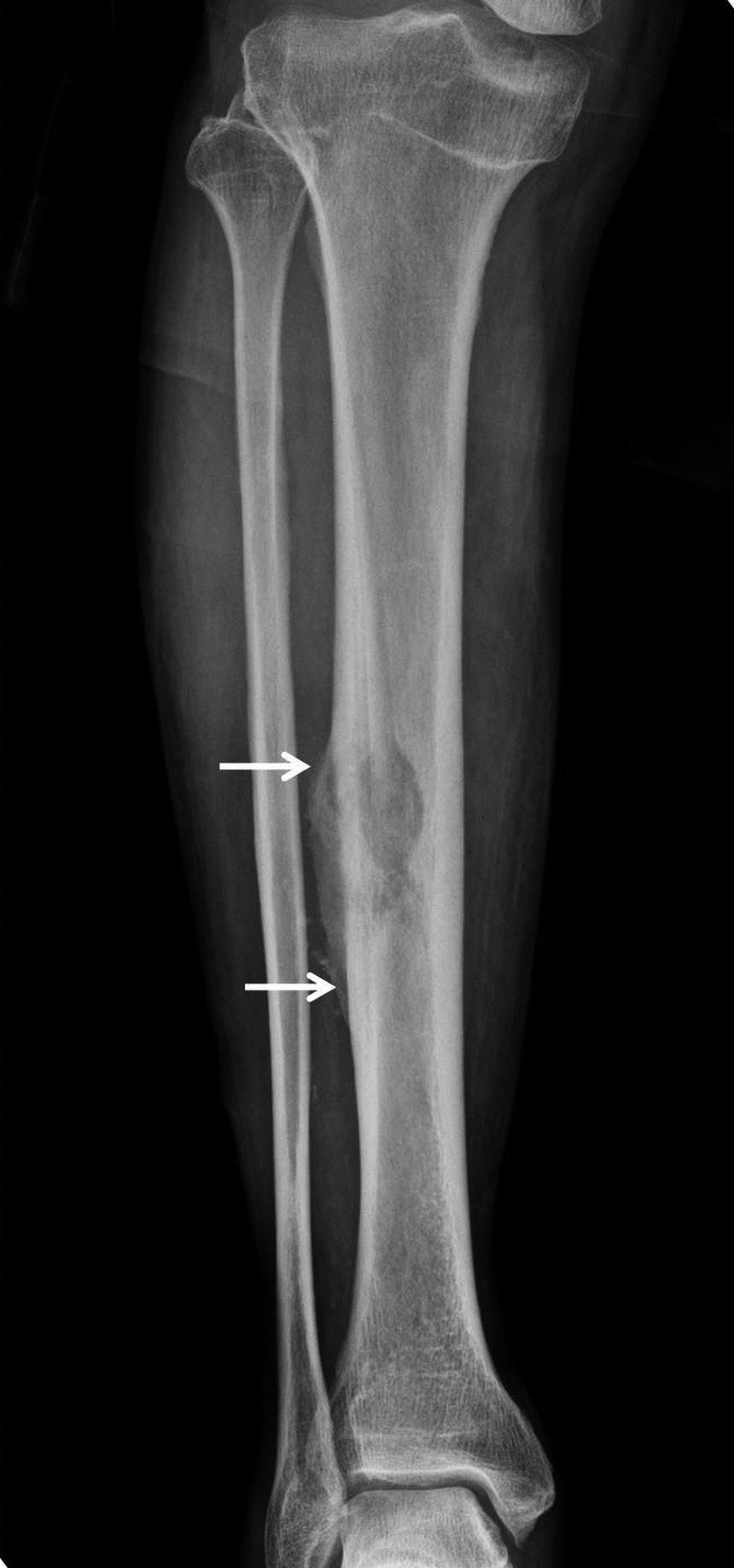 MR Findings of Squamous Cell Carcinoma rising from Chronic Osteomyelitis of the Tibia or amputation (1, 4). The findings of plain radiography are relatively well-described in the literature.