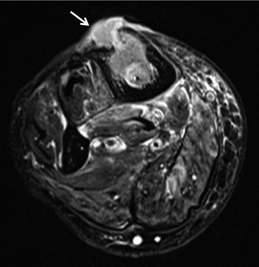 Sagittal T2-weighted fat suppressed image (), sagittal T1-weighted image (), axial T2-weighted fat suppressed image (C), axial T1-weighted image (D) and T1-weighted fat-suppressed image with