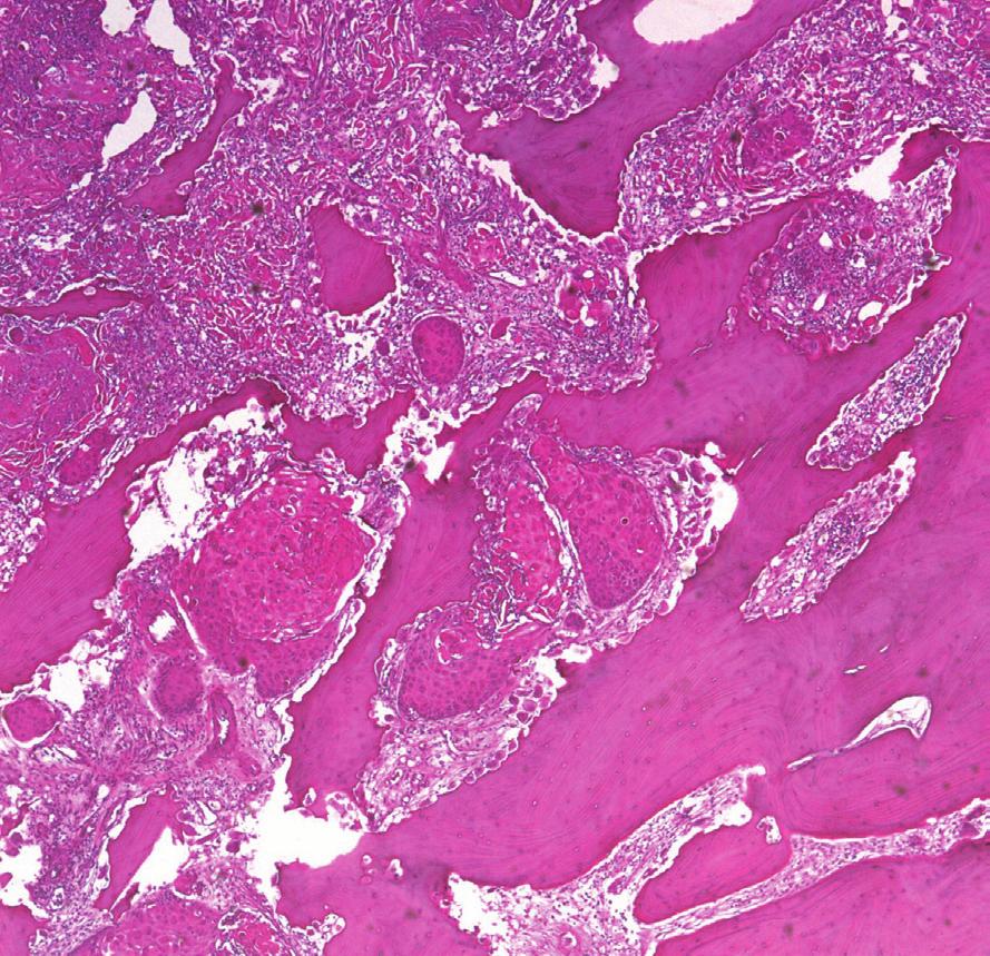MR Findings of Squamous Cell Carcinoma rising from Chronic Osteomyelitis of the Tibia Fig. 4. Pathology.