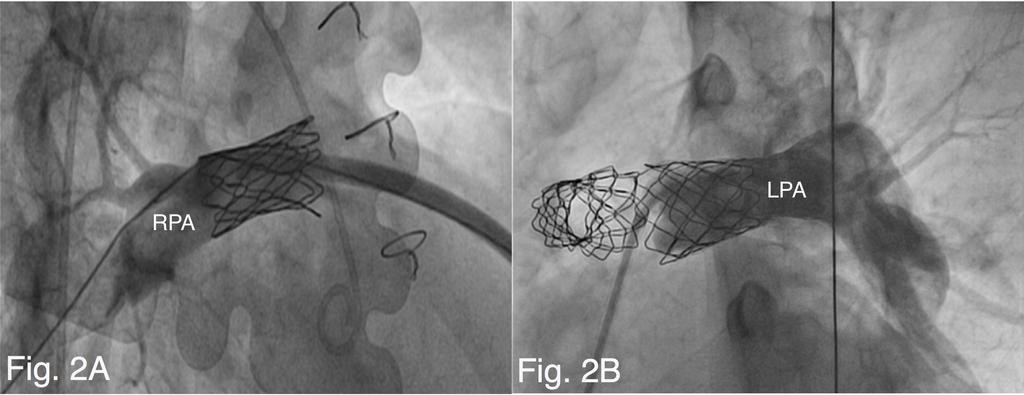 Figure 2. (A) Right pulmonary artery (RPA) angiography after implantation of the RPA Melody valve. There is no insufficiency.