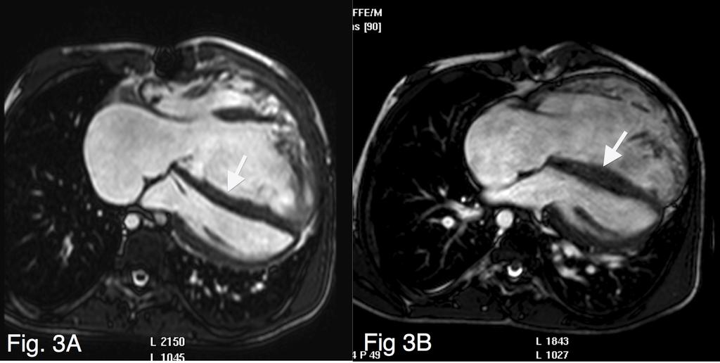 . 3 se 01 lu 2 na MP so H er ht r P rig Fo opy C Figure 3. (A) Magnetic resonance image (MRI) before implantation of the Melody valves.