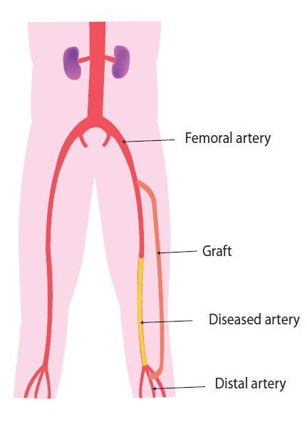 What is a femoro-popliteal bypass graft? The blocked artery must be exposed both above and below the blockage.