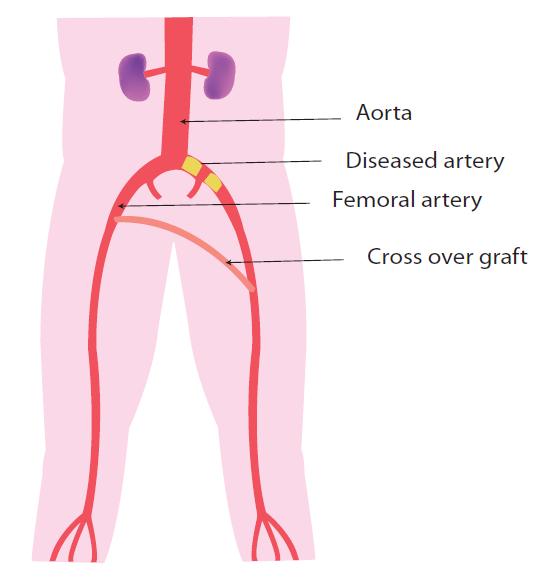 The bypass tube is joined to the artery at groin level and again to the artery below with very fine permanent stitches.