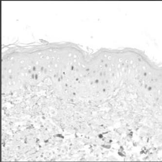 Lower CPDs in Human Biopsies with SOL-IR 5 4 4.