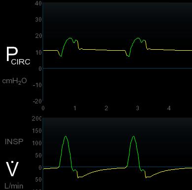 Inspiratory Dysynchrony AC-VT decreased pressure & rounded flow