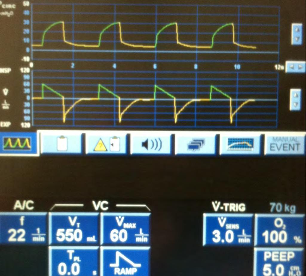 Inspiratory Dysynchrony Recognizing inadequate flow There should be a linear rise