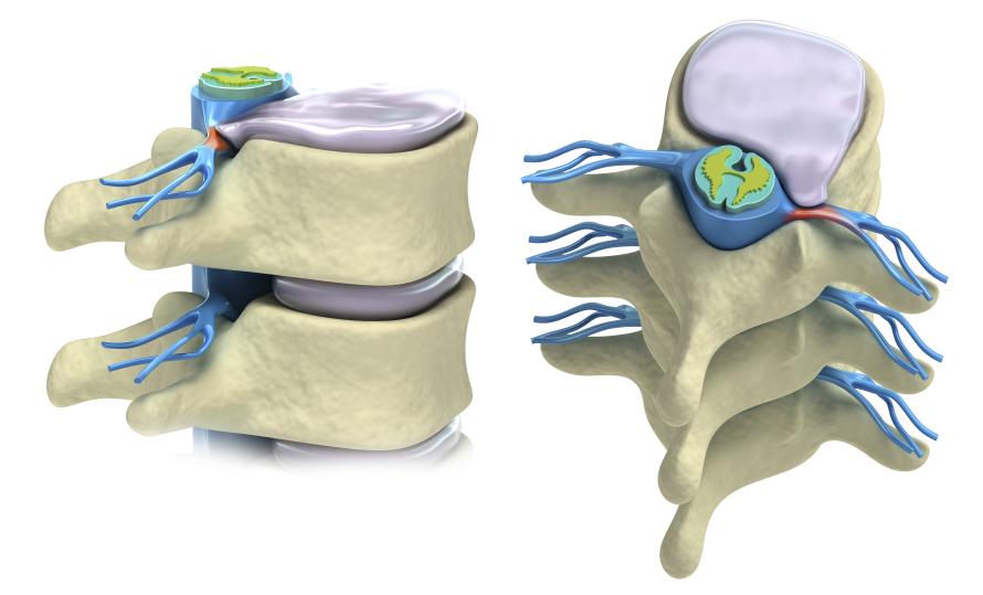 Problems begin to occur in the lower back if the lordosis is lost for prolonged periods of time.