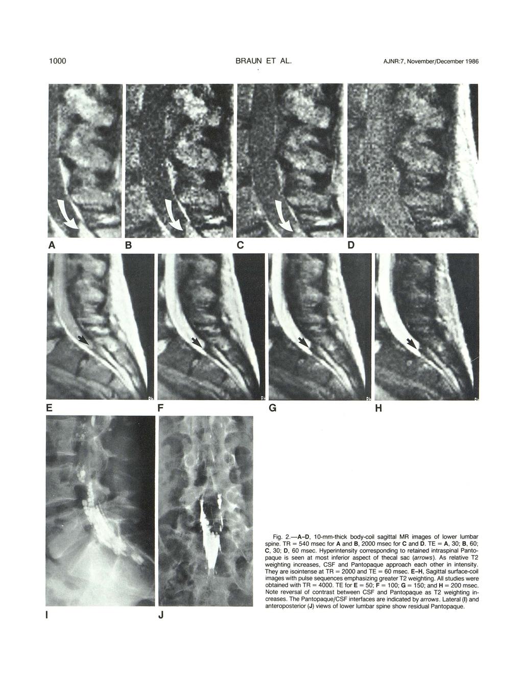 1000 BRAUN ET AL. AJNR : 7, November/December 1986 A B c o E F G H J Fig. 2.-A-D, 10-mm-thick body-coil sagittal MR images of lower lumbar spine. TR = 540 msec for A and e, 2000 msec for C and D.
