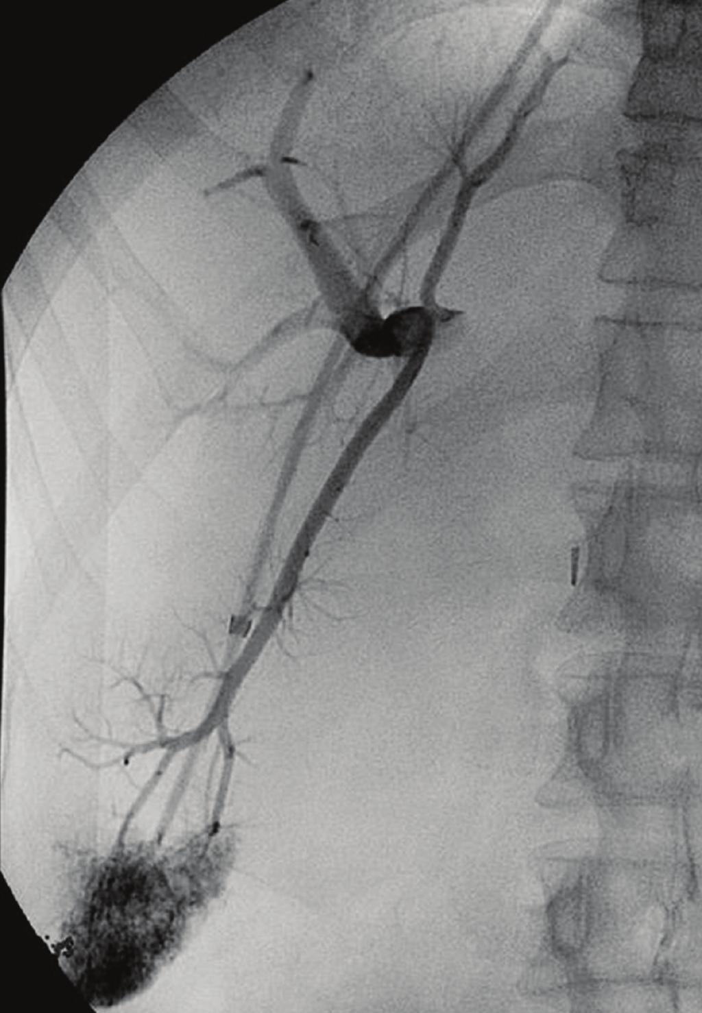 2 International Journal of Hepatology Figure 2: Tract dilatation using a 10 mm angioplasty balloon catheter. The narrowed part of the balloon is in the intraparenchymal part of the tract (arrows).