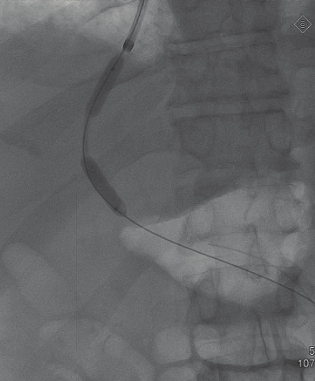 Technical Aspects TIPS is a hemodynamic equivalent of a side-to-side small diameter surgical portacaval shunt.