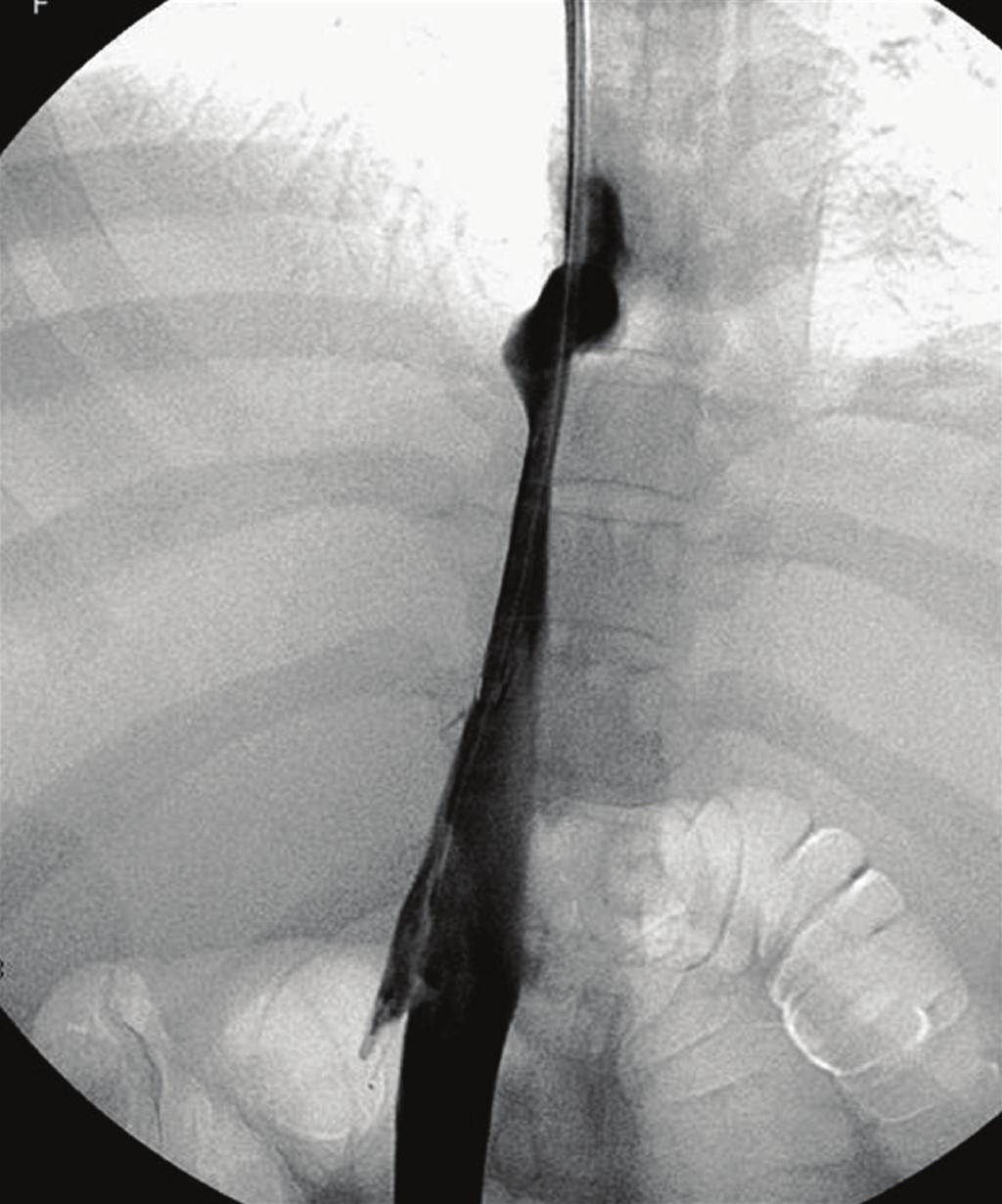 International Journal of Hepatology 7 Figure 8: Cavography in a patient with Budd Chiari syndrome. Note that the right hepatic vein was almost completely occluded (arrow).