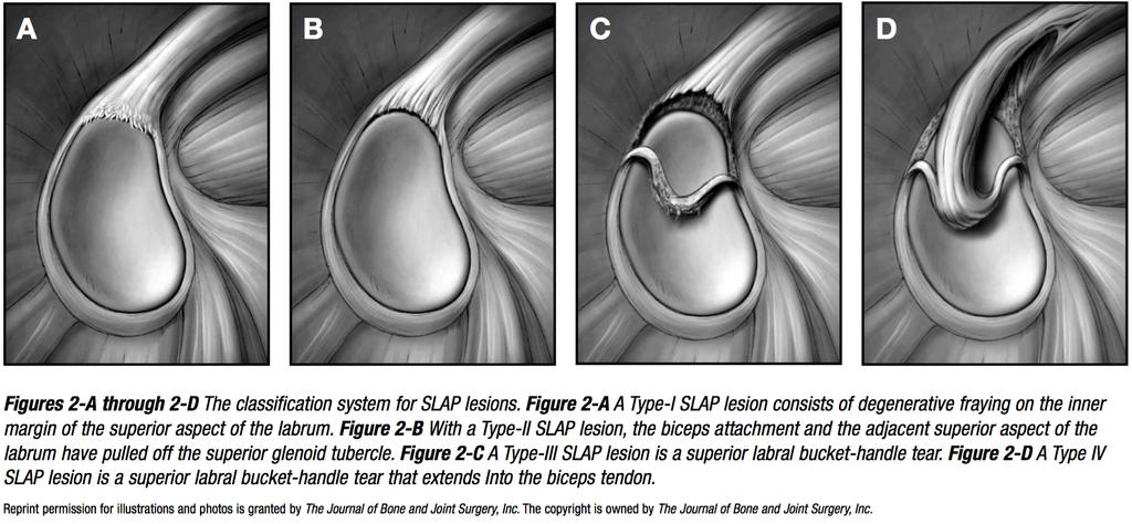 This is because the articular surface f the rund humeral head is apprximately fur times greater than that f the relatively at shulder blade face (glenid fssa)1 (Figure 1).
