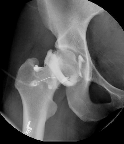 Fluoro-guided intra-articular injection of gadolinium solution(10-15 ml) Disadvantages: Invasive, uncomfortable (however: moderate pain average 2 d)